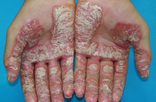 La psoriasis que este tal en las manos